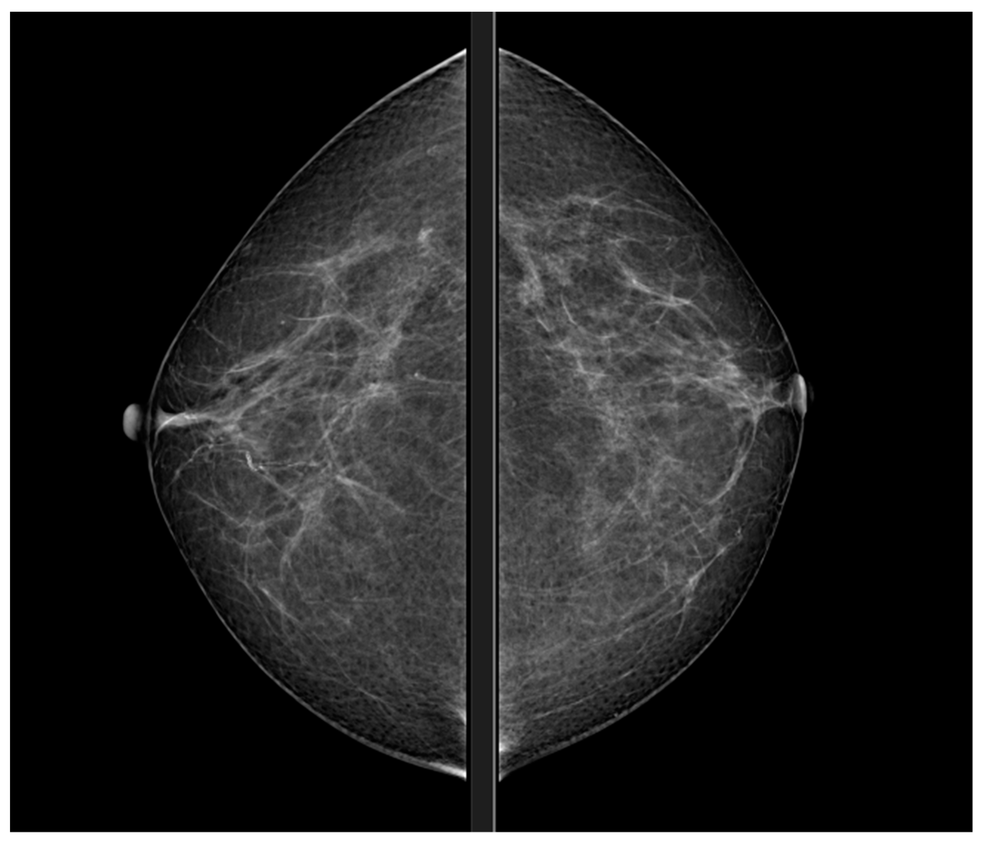 Mammography